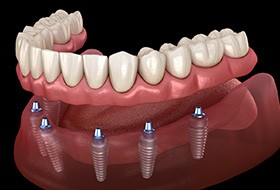 A 3D illustration of an implant denture and its parts