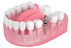 Illustration of a single dental implant