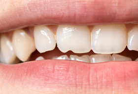 a closeup of a person’s chipped tooth