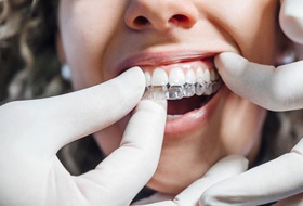 a dentist showing a patient how to put ClearCorrect aligners in their mouth