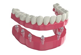 Rendering of lower arch of implant dentures with white background