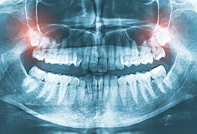 X-ray showing impacted wisdom teeth in upper jaw
