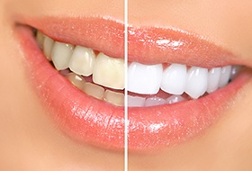 Closeup of a smile that’s half whitened to show before/after treatment results