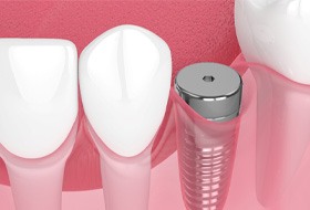 Digital illustration of dental implant