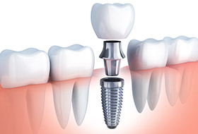 Animation of implant supported dental crown