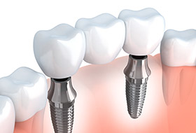 Animation of implant supported fixed bridge