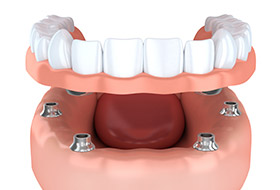 Animation of implant suppored denture