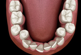 Illustration of crooked teeth