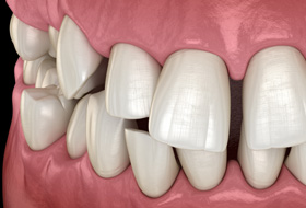 Illustration of gapped teeth