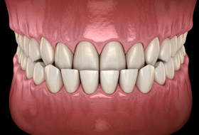Illustration of an underbite
