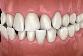 Illustration of a crossbite