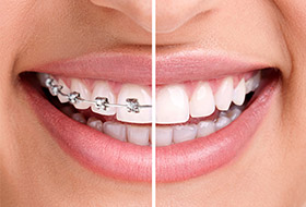 Smile half with braces half with Invisalign