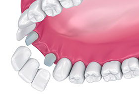 Animation of dental bridge placement