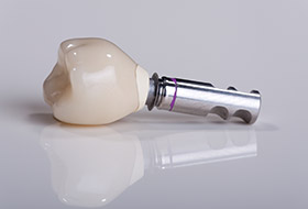 Model of implant supported dental crown