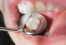 Closeup of repaired tooth