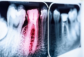 Factors that can affect the cost of a root canal include the location of the infected tooth