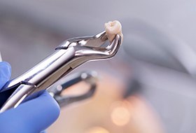 Although it may be more affordable to pull a tooth initially, restoring it can cost more than a root canal would have