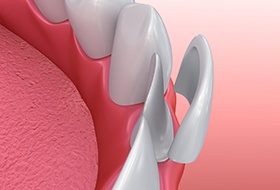 A porcelain veneer being put on a lower tooth