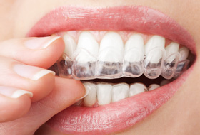  A closeup of a mouth placing a teeth whitening tray