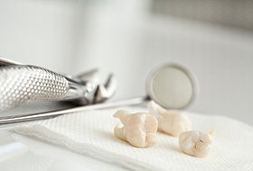 a close-up of extracted wisdom teeth