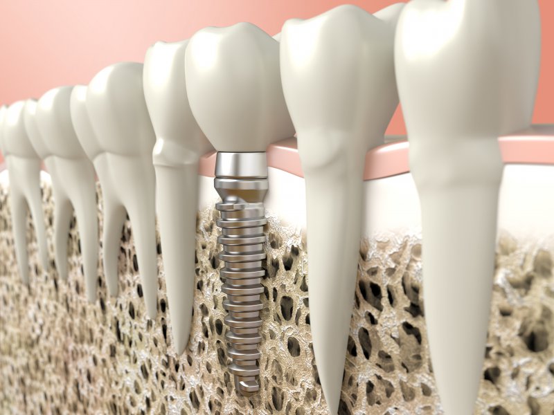 A diagram of a dental implant.