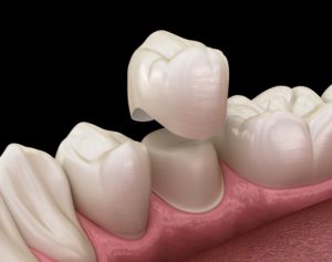 3D illustration of a dental crown 