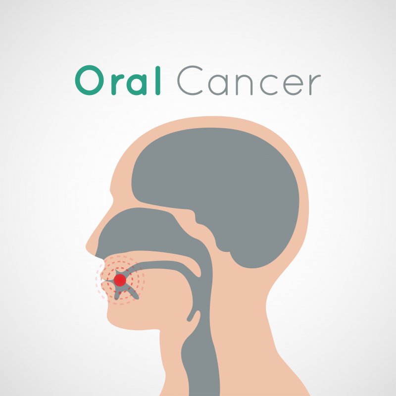image of oral cancer figure
