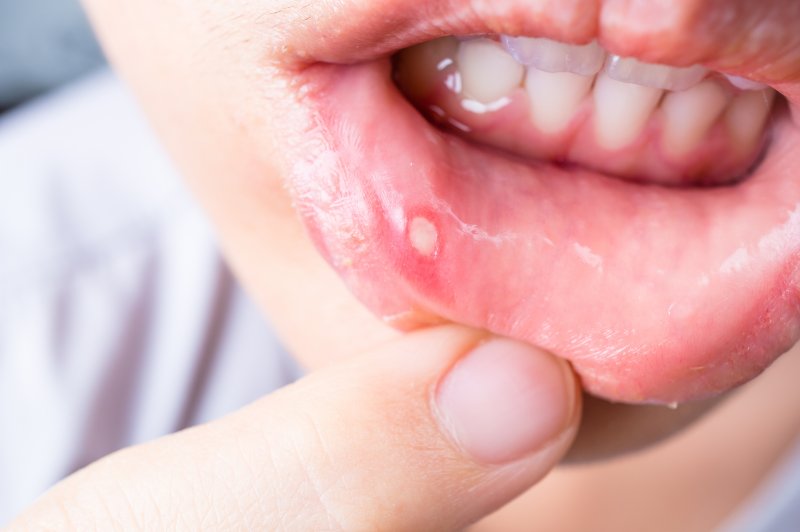 A patient experiencing mouth sores in Wethersfield