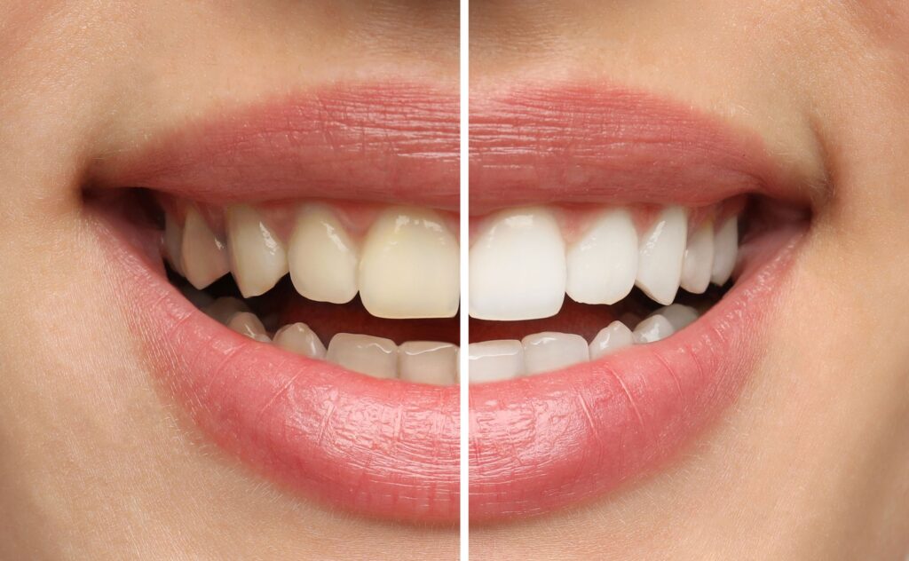 Closeup of someone's smile divided in half to show results of teeth whitening